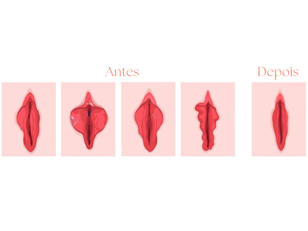 antes e depois ninfoplastia